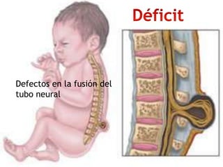 Defectos en la fusión del
tubo neural
 