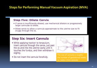 The size of cannula is roughly
the number of gestational weeks
i.e. 7wks= 7mm cannula
20
 