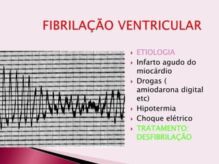  ETIOLOGIA
 Infarto agudo do
miocárdio
 Drogas (
amiodarona digital
etc)
 Hipotermia
 Choque elétrico
 TRATAMENTO:
DESFIBRILAÇÃO
 