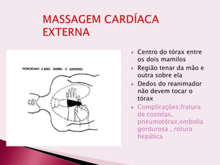  Centro do tórax entre
os dois mamilos
 Região tenar da mão e
outra sobre ela
 Dedos do reanimador
não devem tocar o
tórax
 Complicações:fratura
de costelas,
pneumotórax,embolia
gordurosa , rotura
hepática
 