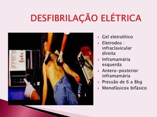  Gel eletrolítico
 Eletrodos :
infraclavicular
direita
 Inframamária
esquerda
 Antero-posterior
inframamária
 Pressão de 6 a 8kg
 Monofásicox bifásico
 