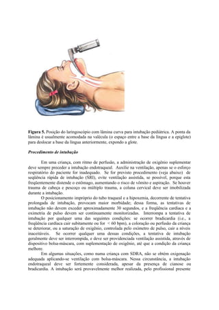 Figura 5. Posição do laringoscópio com lâmina curva para intubação pediátrica. A ponta da
lâmina é usualmente acomodada na valécula (o espaço entre a base da língua e a epiglote)
para deslocar a base da língua anteriormente, expondo a glote.
Procedimento de intubação
Em uma criança, com ritmo de perfusão, a administração de oxigênio suplementar
deve sempre preceder a intubação endotraqueal. Auxilie na ventilação, apenas se o esforço
respiratório do paciente for inadequado. Se for previsto procedimento (veja abaixo) de
seqüência rápida de intubação (SRI), evite ventilação assistida, se possível, porque esta
freqüentemente distende o estômago, aumentando o risco de vômito e aspiração. Se houver
trauma de cabeça e pescoço ou múltiplo trauma, a coluna cervical deve ser imobilizada
durante a intubação.
O posicionamento impróprio do tubo traqueal e a hipoxemia, decorrente de tentativa
prolongada de intubação, provocam maior morbidade; dessa forma, as tentativas de
intubação não devem exceder aproximadamente 30 segundos, e a freqüência cardíaca e a
oximetria de pulso devem ser continuamente monitorizadas. Interrompa a tentativa de
intubação por qualquer uma das seguintes condições: se ocorrer bradicardia (i.e., a
freqüência cardíaca cair subitamente ou for < 60 bpm), a coloração ou perfusão da criança
se deteriorar, ou a saturação de oxigênio, controlada pelo oxímetro de pulso, cair a níveis
inaceitáveis. Se ocorrer qualquer uma dessas condições, a tentativa de intubação
geralmente deve ser interrompida, e deve ser providenciada ventilação assistida, através de
dispositivo bolsa-máscara, com suplementação de oxigênio, até que a condição da criança
melhore.
Em algumas situações, como numa criança com SDRA, não se obtém oxigenação
adequada aplicando-se ventilação com bolsa-máscara. Nessa circunstância, a intubação
endotraqueal deve ser fortemente considerada, apesar da presença de cianose ou
bradicardia. A intubação será provavelmente melhor realizada, pelo profissional presente
 