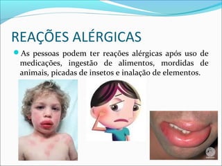 REAÇÕES ALÉRGICAS
As pessoas podem ter reações alérgicas após uso de
medicações, ingestão de alimentos, mordidas de
animais, picadas de insetos e inalação de elementos.
 