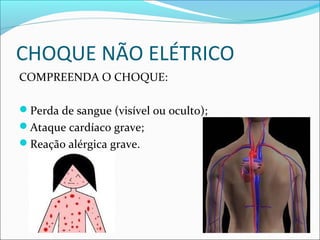 CHOQUE NÃO ELÉTRICO
COMPREENDA O CHOQUE:
Perda de sangue (visível ou oculto);
Ataque cardíaco grave;
Reação alérgica grave.
 