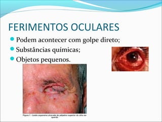 FERIMENTOS OCULARES
Podem acontecer com golpe direto;
Substâncias químicas;
Objetos pequenos.
 