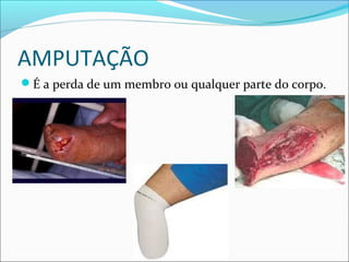 AMPUTAÇÃO
É a perda de um membro ou qualquer parte do corpo.
 