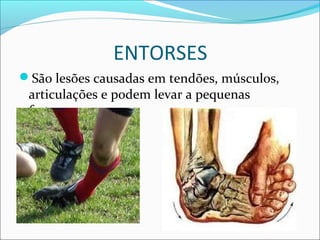 ENTORSES
São lesões causadas em tendões, músculos,
articulações e podem levar a pequenas
fraturas.
 