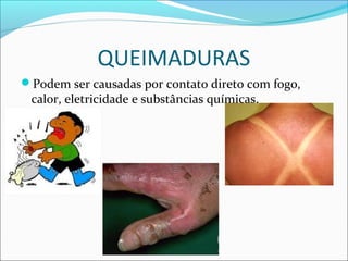 QUEIMADURAS
Podem ser causadas por contato direto com fogo,
calor, eletricidade e substâncias químicas.
 