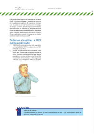 SECÇÃO 4

DESOBSTRUÇÃO DA VIA AÉREA

Obstrução da Via Aérea
33

O reconhecimento precoce da obstrução da via aérea
(OVA) é fundamental para o sucesso da evolução
da situação de emergência. É importante distinguir
esta situação de emergência do desmaio/síncope,
do “ataque cardíaco” (enfarte agudo do miocárdio),
das convulsões, da overdose por drogas e de outras
condições que possam causar insuficiência respiratória
súbita, mas que requerem um tratamento diferente.
O reanimador (observador) treinado geralmente sabe
detetar sinais de obstrução da VA.

notas:

Podemos classificar a OVA
quanto à gravidade:
•	
•	

LIGEIRA: vítima reativa, eventual ruído respiratório
na inspiração, mantém trocas gasosas, mantém
reflexo de tosse eficaz;
GRAVE: incapacidade de chorar (lactente), ruído
agudo alto à inspiração ou ausência total de
ruído, cianose, incapacidade de falar, agarra
pescoço com as mãos (sinal universal de asfixia),
incapacidade de movimentar o ar (trocas gasosas
ineficazes ou ausentes), tosse ineficaz ou ausente.

Figura 18: Sinal universal de asfixia

Definição de "cianose":
Coloração azulada ou violácea da pele, especialmente na face e nas extremidades, devida a
deficiente oxigenação do sangue.

 