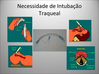 Necessidade de Intubação
Traqueal
 