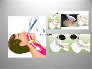 Combitubo
 