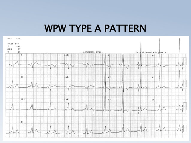 PRE EXCITATION SYNDROMES (THE WOLFF PARKINSON WHITE, LPL, MAHAIM ...