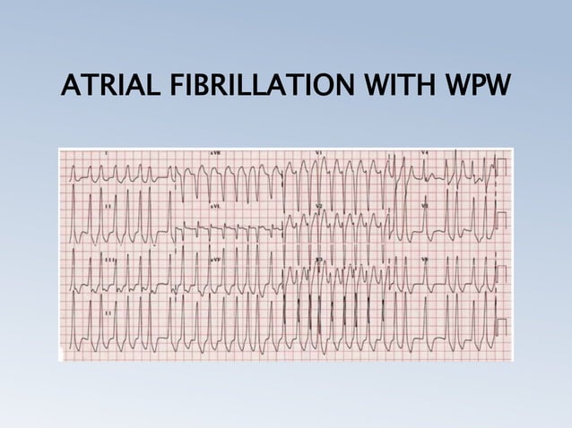 PRE EXCITATION SYNDROMES (THE WOLFF PARKINSON WHITE, LPL, MAHAIM ...
