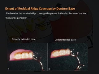 Distal Extension In removable partial denture | PPTX