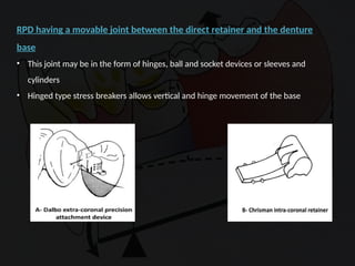Distal Extension In removable partial denture | PPTX
