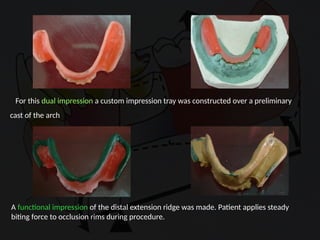 Distal Extension In removable partial denture | PPTX