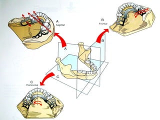 Distal Extension In removable partial denture | PPTX