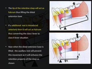 Distal Extension In removable partial denture | PPTX