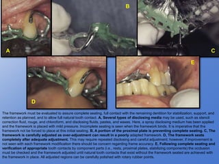 The framework must be evaluated to assure complete seating, full contact with the remaining dentition for stabilization, support, and
retention as planned, and to allow full natural tooth contact. A, Several types of disclosing media may be used, such as stencil
correction fluid, rouge, and chloroform, and disclosing fluids, pastes, and waxes. Here, a spray disclosing medium has been applied
and the framework is placed with mild pressure. Incomplete seating is seen when the framework binds. It is imperative that the
framework not be forced to place at this initial seating. B, A portion of the proximal plate is preventing complete seating. C, The
framework is carefully adjusted as over-adjustment can result in a poorly adapted framework. D, The framework seats
completely after adequate adjustment. This may require repeated disclosing and careful adjustment; however, if improvement is
not seen with each framework modification there should be concern regarding frame accuracy. E, Following complete seating and
verification of appropriate tooth contacts by component parts (i.e., rests, proximal plates, stabilizing components) the occlusion
must be checked and the framework adjusted until natural tooth contacts that exist without the framework seated are achieved with
the framework in place. All adjusted regions can be carefully polished with rotary rubber points.
A
B
C
D
E
 