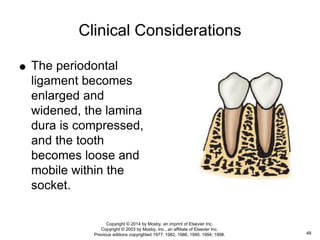 Clinical Considerations
 The periodontal
ligament becomes
enlarged and
widened, the lamina
dura is compressed,
and the tooth
becomes loose and
mobile within the
socket.
48
Copyright © 2014 by Mosby, an imprint of Elsevier Inc.
Copyright © 2003 by Mosby, Inc., an affiliate of Elsevier Inc.
Previous editions copyrighted 1977, 1982, 1986, 1990, 1994, 1998.
 