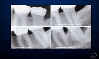 14 months after surgical therapy
35
7 years after surgery
2 years after surgery
 