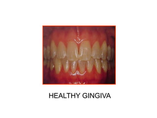 HEALTHY GINGIVA
 