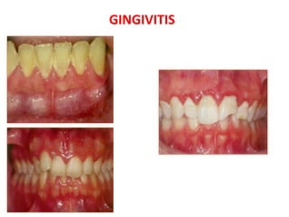 GINGIVITIS
Plaque induced
Erythematous gingiva
 
