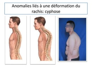 Anomalies liés à une déformation du
rachis: cyphose
 