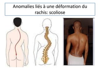 Anomalies liés à une déformation du
rachis: scoliose
 