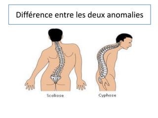 Différence entre les deux anomalies
 