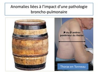 Anomalies liées à l’impact d’une pathologie
broncho-pulmonaire
Thorax en Tonneau
 