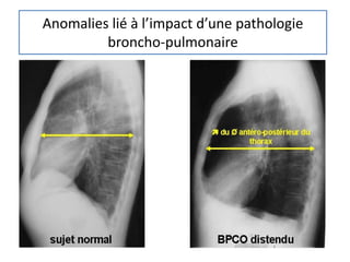 Anomalies lié à l’impact d’une pathologie
broncho-pulmonaire
 