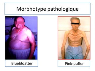 Morphotype pathologique
Bluebloatter Pink-puffer
 