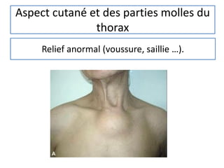 Aspect cutané et des parties molles du
thorax
Relief anormal (voussure, saillie …).
 