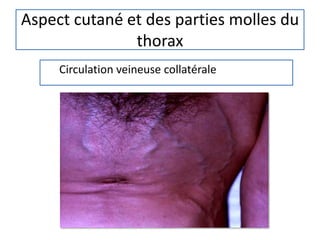 Aspect cutané et des parties molles du
thorax
Circulation veineuse collatérale
 