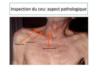 Inspection du cou: aspect pathologique
 