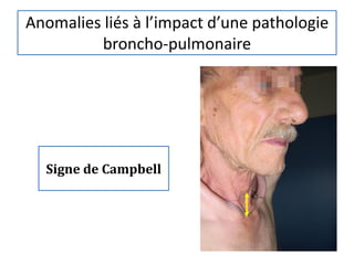 Anomalies liés à l’impact d’une pathologie
broncho-pulmonaire
Signe de Campbell
 