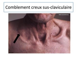 Comblement creux sus-claviculaire
 
