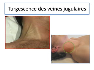 Turgescence des veines jugulaires
 