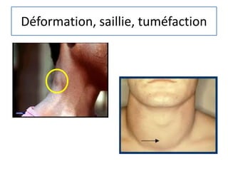 Déformation, saillie, tuméfaction
 