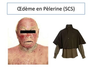 Œdème en Pèlerine (SCS)
 
