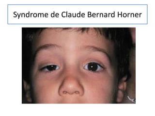 Syndrome de Claude Bernard Horner
 