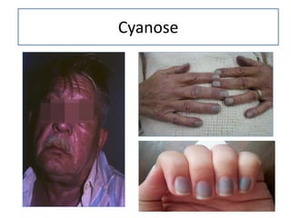 Cyanose
 