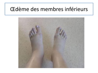 Œdème des membres inférieurs
 
