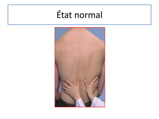 État normal
 