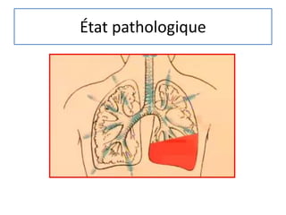État pathologique
 