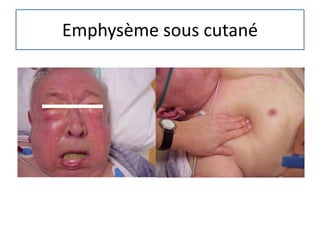 Emphysème sous cutané
 