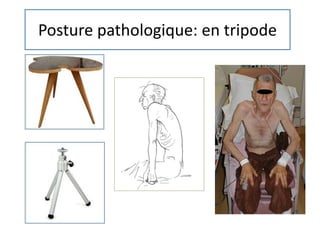 Posture pathologique: en tripode
 