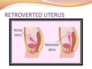 RETROVERTED UTERUS
 