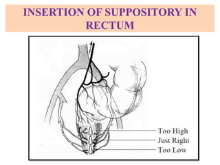 INSERTION OF SUPPOSITORY IN
RECTUM
 